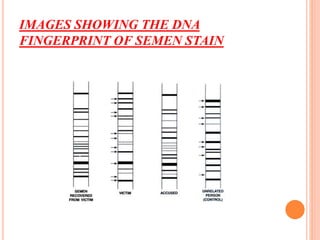 IMAGES SHOWING THE DNA
FINGERPRINT OF SEMEN STAIN
 