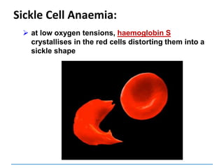 Sickle Cell Anaemia:
 at low oxygen tensions, haemoglobin S
crystallises in the red cells distorting them into a
sickle shape
 