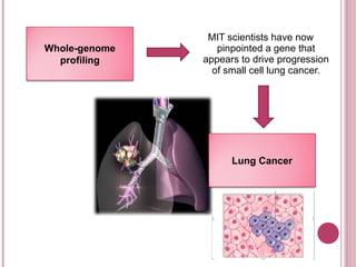 MIT scientists have now pinpointed a gene that appears to drive progression of small cell lung cancer. Whole-genome profiling Lung Cancer 