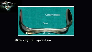 Sims vaginal speculum
 