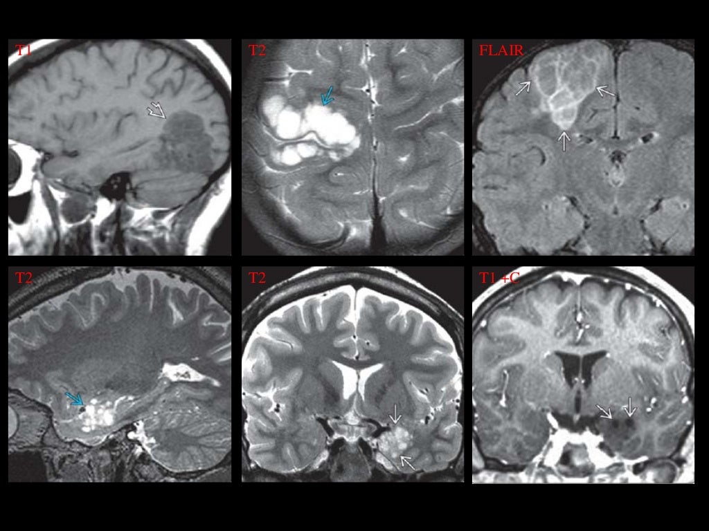 Dysembryoplastic neuroepithelial tumor