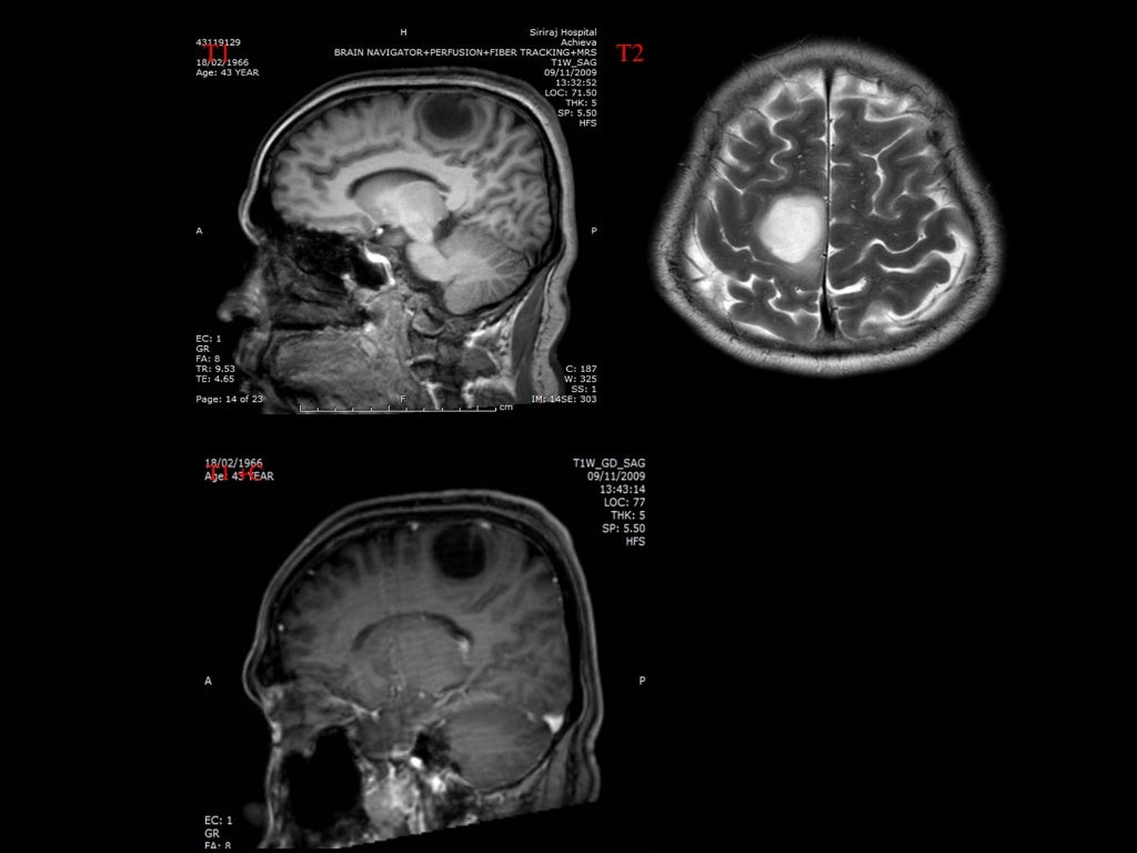 Dysembryoplastic neuroepithelial tumor