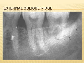 Obliuqe Ridge D Normal Anatomy in Dental Radiography.pptx