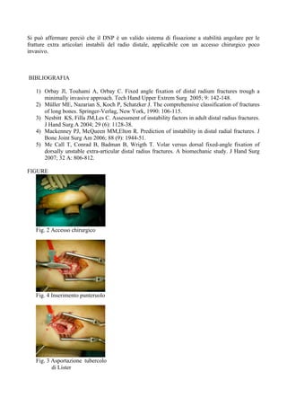 Si può affermare perciò che il DNP è un valido sistema di fissazione a stabilità angolare per le
fratture extra articolari instabili del radio distale, applicabile con un accesso chirurgico poco
invasivo.

BIBLIOGRAFIA
1) Orbay Jl, Touhami A, Orbay C. Fixed angle fixation of distal radium fractures trough a
minimally invasive approach. Tech Hand Upper Extrem Surg 2005; 9: 142-148.
2) Müller ME, Nazarian S, Koch P, Schatzker J. The comprehensive classification of fractures
of long bones. Springer-Verlag, New York, 1990: 106-115.
3) Nesbitt KS, Filla JM,Les C. Assessment of instability factors in adult distal radius fractures.
J Hand Surg A 2004; 29 (6): 1128-38.
4) Mackenney PJ, McQueen MM,Elton R. Prediction of instability in distal radial fractures. J
Bone Joint Surg Am 2006; 88 (9): 1944-51.
5) Mc Call T, Conrad B, Badman B, Wrigth T. Volar versus dorsal fixed-angle fixation of
dorsally unstable extra-articular distal radius fractures. A biomechanic study. J Hand Surg
2007; 32 A: 806-812.
FIGURE

Fig. 2 Accesso chirurgico

Fig. 4 Inserimento punteruolo

Fig. 3 Asportazione tubercolo
di Lister

 