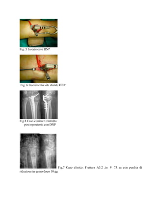 Fig. 5 Inserimento DNP

Fig. 6 Inserimento vite distale DNP

Fig.8 Caso clinico: Controllo
post operatorio con DNP

Fig.7 Caso clinico: Frattura A3.2 ,in ♀ 73 aa con perdita di
riduzione in gesso dopo 10 gg

 