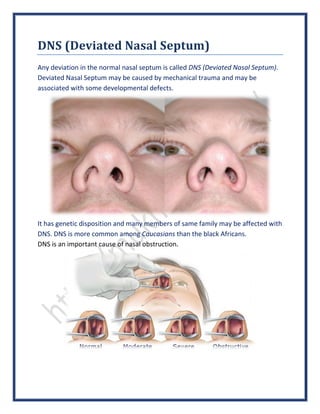 DNS (Deviated Nasal Septum)
Any deviation in the normal nasal septum is called DNS (Deviated Nasal Septum).
Deviated Nasal Septum may be caused by mechanical trauma and may be
associated with some developmental defects.
It has genetic disposition and many members of same family may be affected with
DNS. DNS is more common among Caucasians than the black Africans.
DNS is an important cause of nasal obstruction.
 