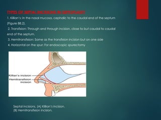 Transfixion Incision Rhinoplasty DNS TREATMENT AND ITS MANAGEMENT TECHNIQUES | PPTX