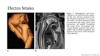 Efectos fetales
RadioGraphics 2017; 37:1840–1850
 