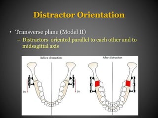 Distraction Osteogenesis in Orthodontics | PPTX
