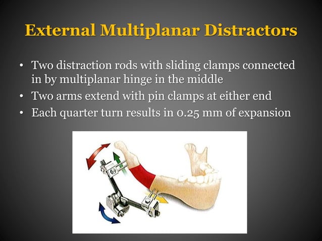Distraction Osteogenesis in Orthodontics | PPTX