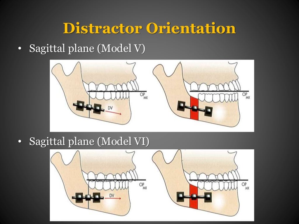 Distraction Osteogenesis in Orthodontics