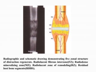 Radiographic and schematic drawing demonstrating five zonal structure
of distraction regenerate. Radiolucent fibrous interzone(FZ); Radiodense
mineralizing zone(MZ); Radiolucent zone of remodeling(RZ); Residual
host bone segments(RHBS).
 