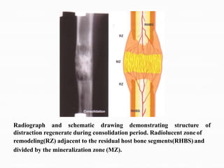 Radiograph and schematic drawing demonstrating structure of
distraction regenerate during consolidation period. Radiolucent zone of
remodeling(RZ) adjacent to the residual host bone segments(RHBS) and
divided by the mineralization zone (MZ).
 