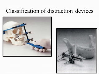Classification of distraction devices
38
 