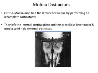 Molina Distractors
• Ortiz & Molina modified the Ilizarov technique by performing an
incomplete corticotomy.
• They left the internal cortical plate and the cancellous layer intact &
used a semi rigid external distractor.
 