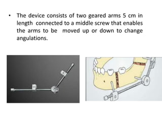 • The device consists of two geared arms 5 cm in
length connected to a middle screw that enables
the arms to be moved up or down to change
angulations.
 