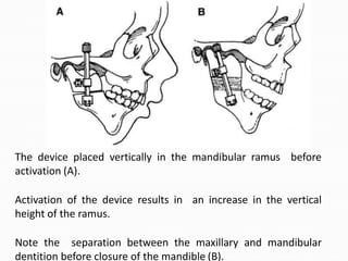 The device placed vertically in the mandibular ramus before
activation (A).
Activation of the device results in an increase in the vertical
height of the ramus.
Note the separation between the maxillary and mandibular
dentition before closure of the mandible (B).
 