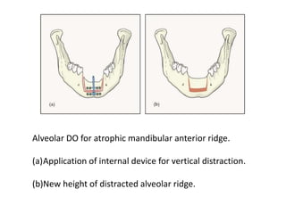 Distraction Osteogenesis | PPTX