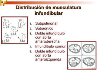 Distribución de musculatura
        infundibular

     1.   Subpulmonar
     2.   Subaórtico
     3.   Doble infundíbulo
          con aorta
          anteroderecha
     4.   Infundíbulo común
     5.   Doble infundíbulo
          con aorta
          anteroizquierda
 