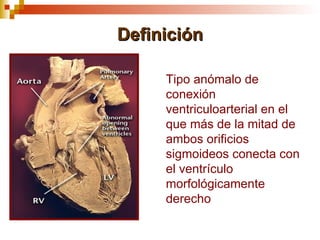 Definición

     Tipo anómalo de
     conexión
     ventriculoarterial en el
     que más de la mitad de
     ambos orificios
     sigmoideos conecta con
     el ventrículo
     morfológicamente
     derecho
 