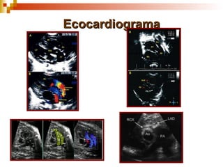 Ecocardiograma
 