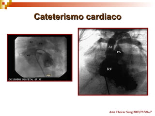 Cateterismo cardiaco




                 Ann Thorac Surg 2003;75:586–7
 