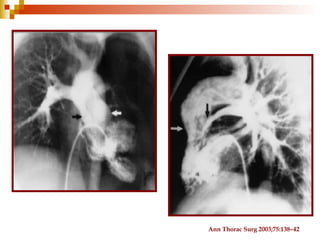 Ann Thorac Surg 2003;75:138–42
 