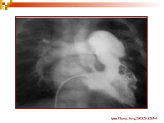 Ann Thorac Surg 2003;76:1283–6
 