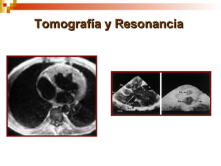 Tomografía y Resonancia
 