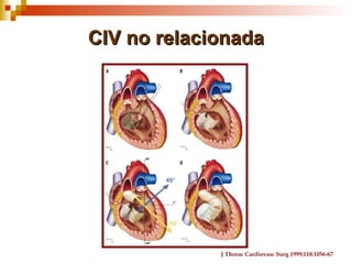 CIV no relacionada




             J Thorac Cardiovasc Surg 1999;118:1056-67
 