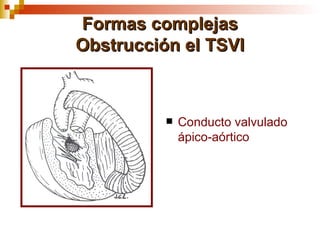 Formas complejas
Obstrucción el TSVI



             Conducto valvulado
              ápico-aórtico
 