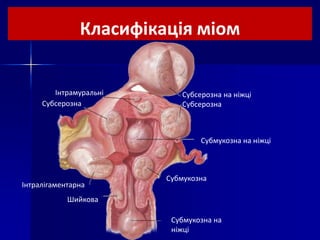 Класифікація міом
Субсерозна на ніжці
Субсерозна
Субмукозна на ніжці
Субмукозна
Субмукозна на
ніжці
Шийкова
Інтралігаментарна
Субсерозна
Інтрамуральні
 
