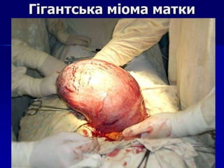 Гігантська міома матки
 