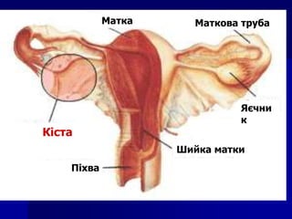 Піхва
Шийка матки
Яєчни
к
Маткова трубаМатка
Кіста
 
