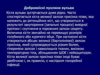 Доброякісні пухлини вульви
Кіста вульви зустрічається дуже рідко. Часто
спостерігається кіста великої залози присінка піхви, яка
належить до ретенційних кіст, що утворюються в
результаті закупорення (запальні процеси) вивідної
протоки і скупчення в порожнині залози секрету.
Величина кісти звичайно не перевищує розмірів
голубиного або курячого яйця. При нагноєнні кісти
утворюється абсцес великої (бартолінієвої) залози
присінка, який супроводжується різким болем,
гіперемією залози і навколишніх тканин, високою
температурою тіла, збільшенням ШОЕ і лейкоцитозом.
Кіста великої залози присінка піхви іноді буває
двобічною і, як правило, є наслідком гонорейної
інфекції.
 
