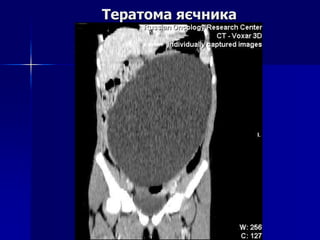 Тератома яєчника
 