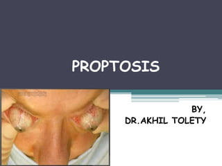 PROPTOSIS
BY,
DR.AKHIL TOLETY
 