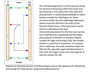 Diagram to illustrate division of kidney biopsy cores in the absence of a dissecting
microscope for laboratories using immunofluorescence
The standard approach is to first procure tissue
for electron microscopy (EM) from each core
by removing 1 mm cubes from the ends and
placing them in cooled glutaraldehyde or other
fixative suitable for EM [Figure 4]. Some
clinicians prefer that the pathology laboratory
obtain tissue for EM from the ends of the
formalin-fixed tissue. If the specimen is to be
sent to a laboratory that uses
immunofluorescence (IF), the first core can be
cut in half by cross-sectioning and the larger
piece placed in formalin or another fixative
suitable for light microscopy (LM); the smaller
portion is saved for IF evaluation. If a second
core is obtained, the ends should be taken for
EM and the specimen again divided almost in
half, with the larger tissue core now kept for IF
and the smaller for LM.
 