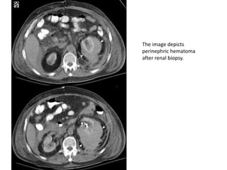 The image depicts
perinephric hematoma
after renal biopsy.
 