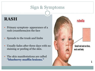 RUBELLA