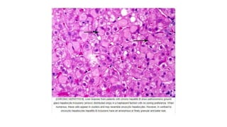 Chronic Hepatitis B Infection | PPTX