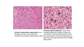 Chronic Hepatitis B Infection | PPTX