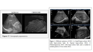 Chronic Hepatitis B Infection | PPTX