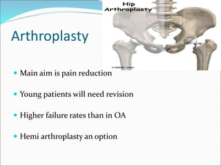 Arthroplasty
 Main aim is pain reduction
 Young patients will need revision
 Higher failure rates than in OA
 Hemi arthroplasty an option
 