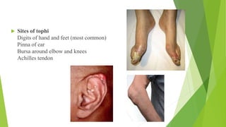 Gouty arthritis (वातरक्त) Pain and inflammation occur when too much ...