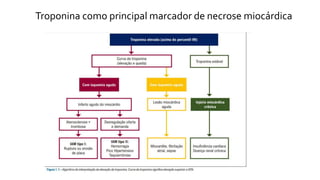 Troponina como principal marcador de necrose miocárdica
 
