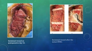 Incisional wound after the
initial STSG.
Incisional wound on
postoperative day 15.
 