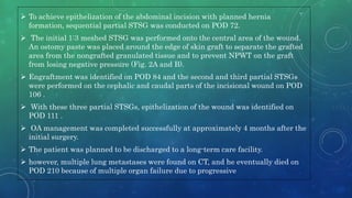  To achieve epithelization of the abdominal incision with planned hernia
formation, sequential partial STSG was conducted on POD 72.
 The initial 1:3 meshed STSG was performed onto the central area of the wound.
An ostomy paste was placed around the edge of skin graft to separate the grafted
area from the nongrafted granulated tissue and to prevent NPWT on the graft
from losing negative pressure (Fig. 2A and B).
 Engraftment was identified on POD 84 and the second and third partial STSGs
were performed on the cephalic and caudal parts of the incisional wound on POD
106 .
 With these three partial STSGs, epithelization of the wound was identified on
POD 111 .
 OA management was completed successfully at approximately 4 months after the
initial surgery.
 The patient was planned to be discharged to a long-term care facility.
 however, multiple lung metastases were found on CT, and he eventually died on
POD 210 because of multiple organ failure due to progressive
 