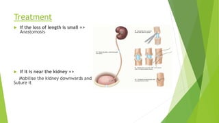 Treatment
 If the loss of length is small =>
Anastomosis
 If it is near the kidney =>
Mobilise the kidney downwards and
Suture it
 