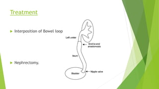  Interposition of Bowel loop
Treatment
 Nephrectomy.
 